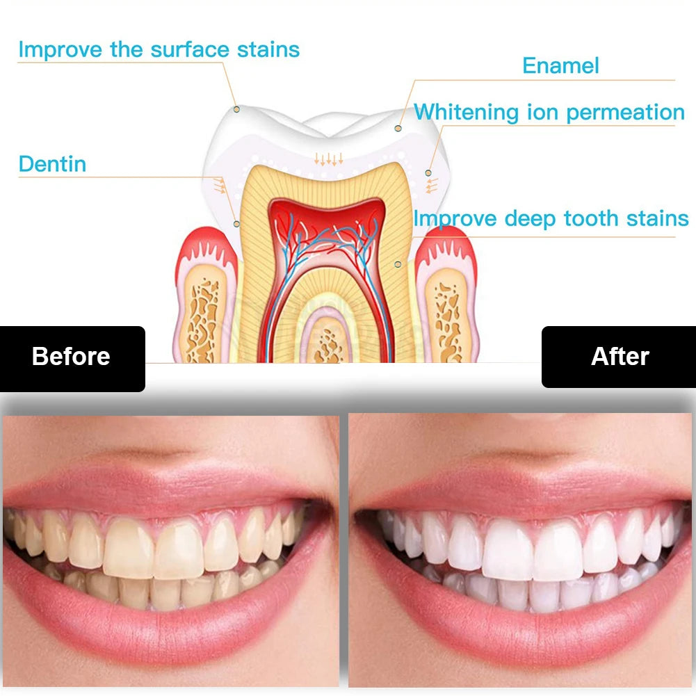 Dental Teeth Whitening Kit